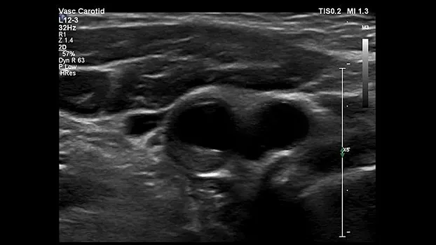 Клинические изображения Philips EPIQ 5 ультразвуковой аппарат