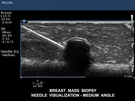 Клинические изображения Philips CX50 ультразвуковой аппарат