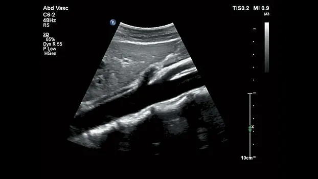 Клинические изображения Philips Affiniti 30 ультразвуковой аппарат