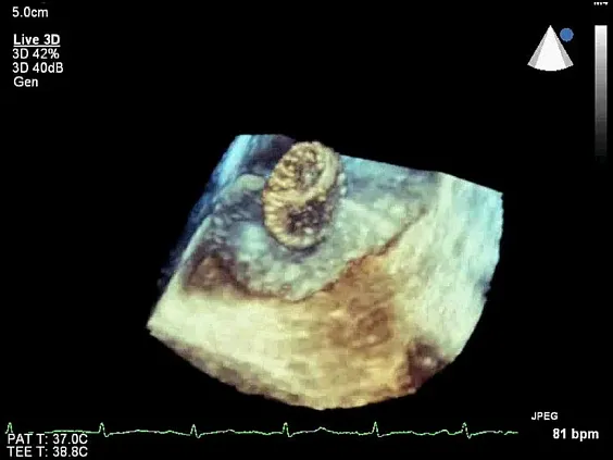Клинические изображения Philips iE33 xMatrix ультразвуковой аппарат
