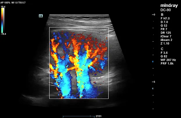 Клинические изображения УЗИ аппарат Mindray DC-90 Exp