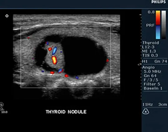 Клинические изображения Philips HD11 XE ультразвуковой аппарат