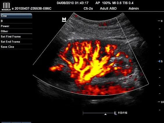Клинические изображения УЗИ аппарат Mindray M7 Premium портативный