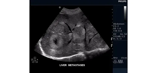 Клинические изображения Philips HD15 ультразвуковой аппарат