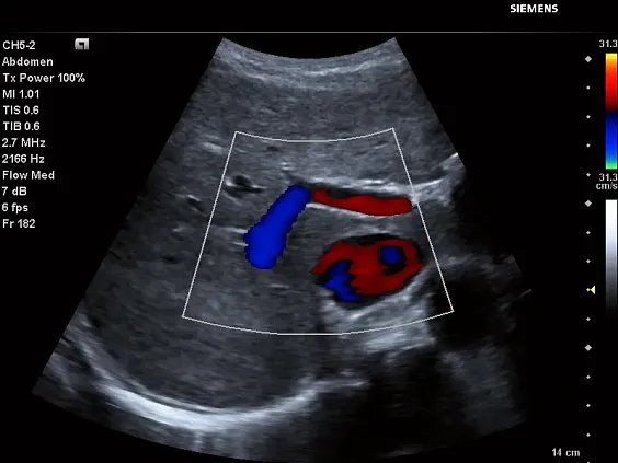 Клинические изображения Siemens Acuson P500 портативный аппарат УЗИ