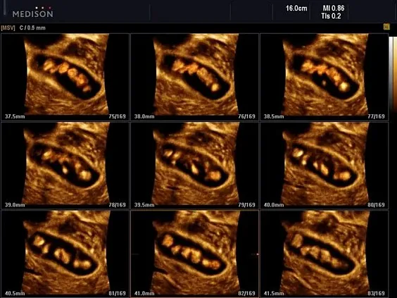 Клинические изображения Samsung Medison Accuvix XG УЗИ аппарат