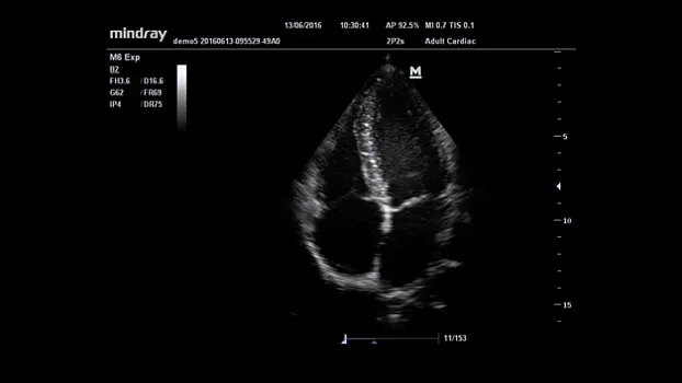 Клинические изображения УЗИ аппарат Mindray M6 портативный