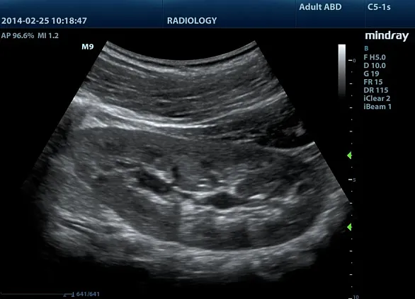 Клинические изображения УЗИ аппарат Mindray M8 портативный