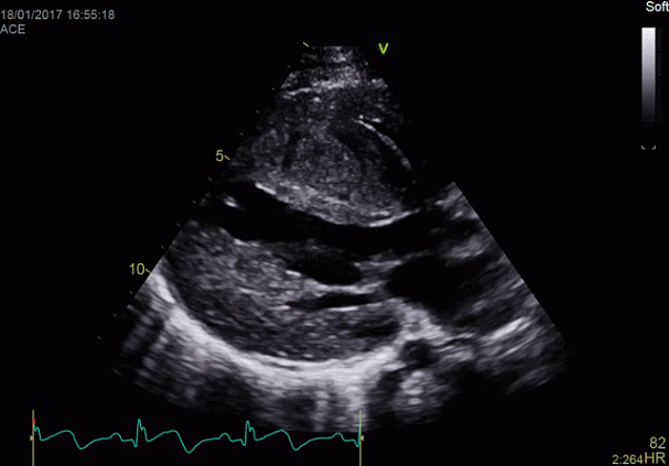 Клинические изображения УЗИ аппарат GE HealthCare Vivid E90