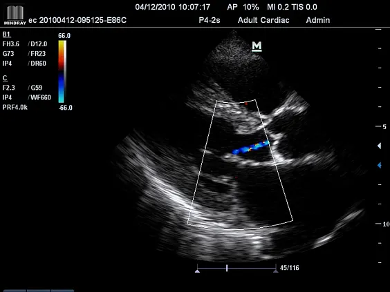 Клинические изображения УЗИ аппарат Mindray M7 Premium портативный