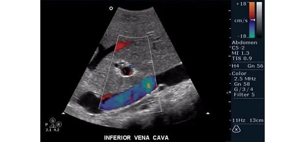 Клинические изображения Philips HD15 ультразвуковой аппарат