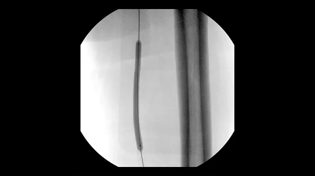 Ангиопластика, 21 см