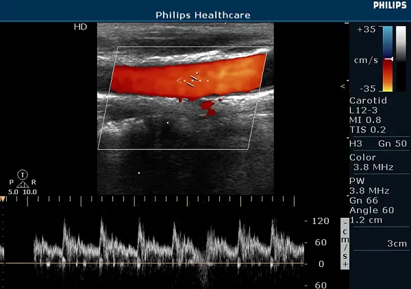 Клинические изображения Philips HD5 ультразвуковой аппарат
