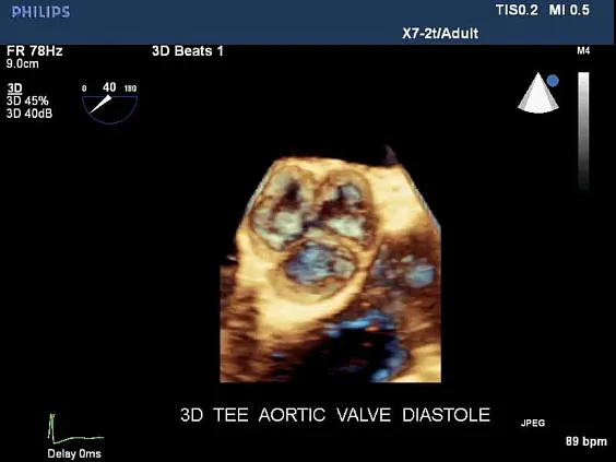 Клинические изображения Philips iE33 xMatrix ультразвуковой аппарат