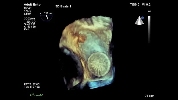 Клинические изображения Philips EPIQ 5 ультразвуковой аппарат