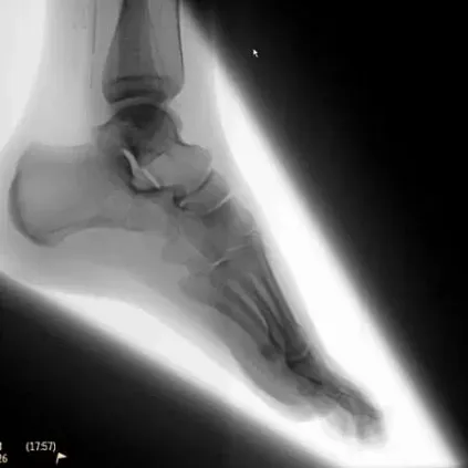 Клинические изображения Philips Zenition 70 C-дуга