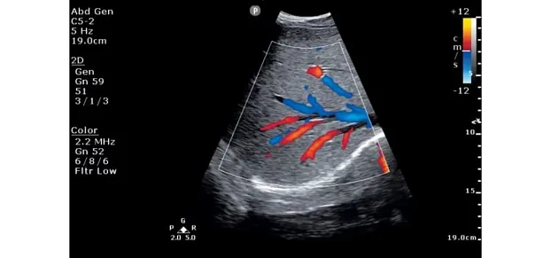 Клинические изображения Philips ClearVue 850 ультразвуковой аппарат